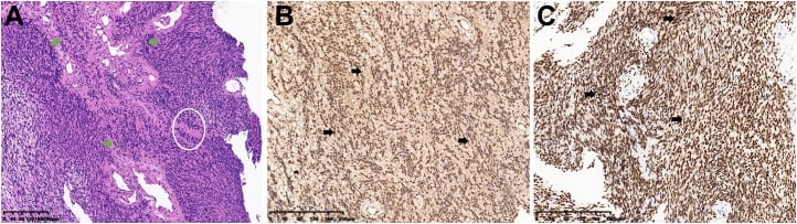 Schwannoma histology showing an Antoni A area, Verocay body and diffuse S100 and SOX10 immunostaining