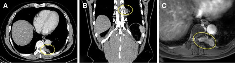Axial and coronal CT with MRI showing a T9 dumbbell tumour traversing the neural foramen