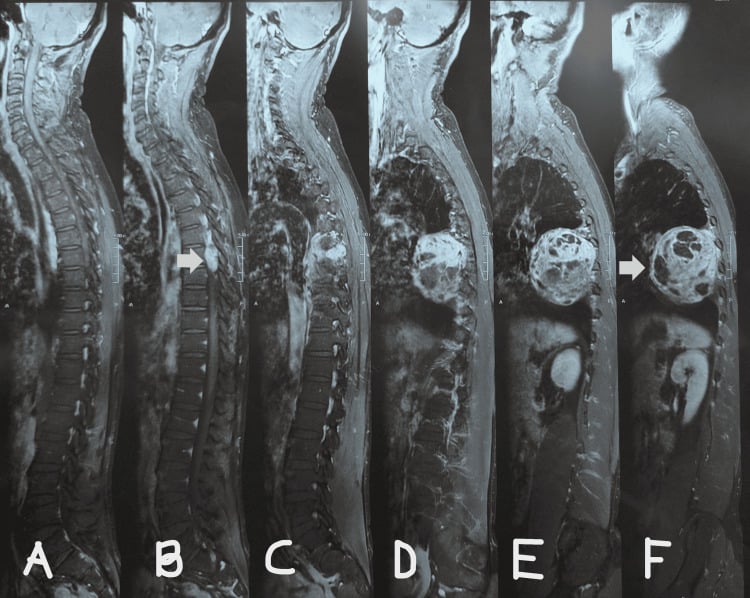 Serial sagittal MRI planes showing intraspinal, foraminal and intrathoracic components of a thoracic dumbbell schwannoma
