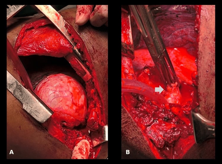 Operative views of intrathoracic and intraspinal components of a thoracic dumbbell schwannoma
