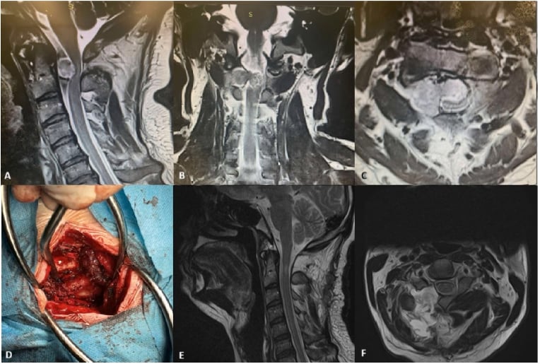 MRI and operative sequence showing unilateral hemilaminectomy resection of a dumbbell spinal schwannoma