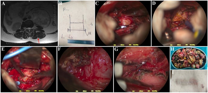 Operative sequence of a muscle-splitting Weaver approach to a paravertebral lumbar schwannoma