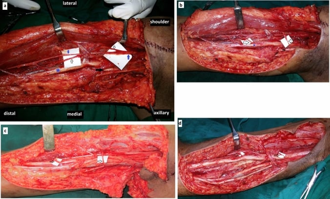 Medial arm operative dissection demonstrating musculocutaneous, median and ulnar nerves and the biceps and brachialis motor branches for double fascicular transfer.