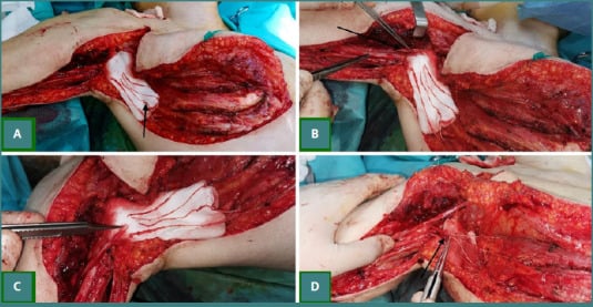 Four-step operative sequence harvesting intercostal nerves and coapting them to the musculocutaneous nerve.