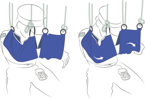 Illustration of gravity-eliminated elbow-flexion exercises using suspension slings and EMG biofeedback after double fascicular transfer.