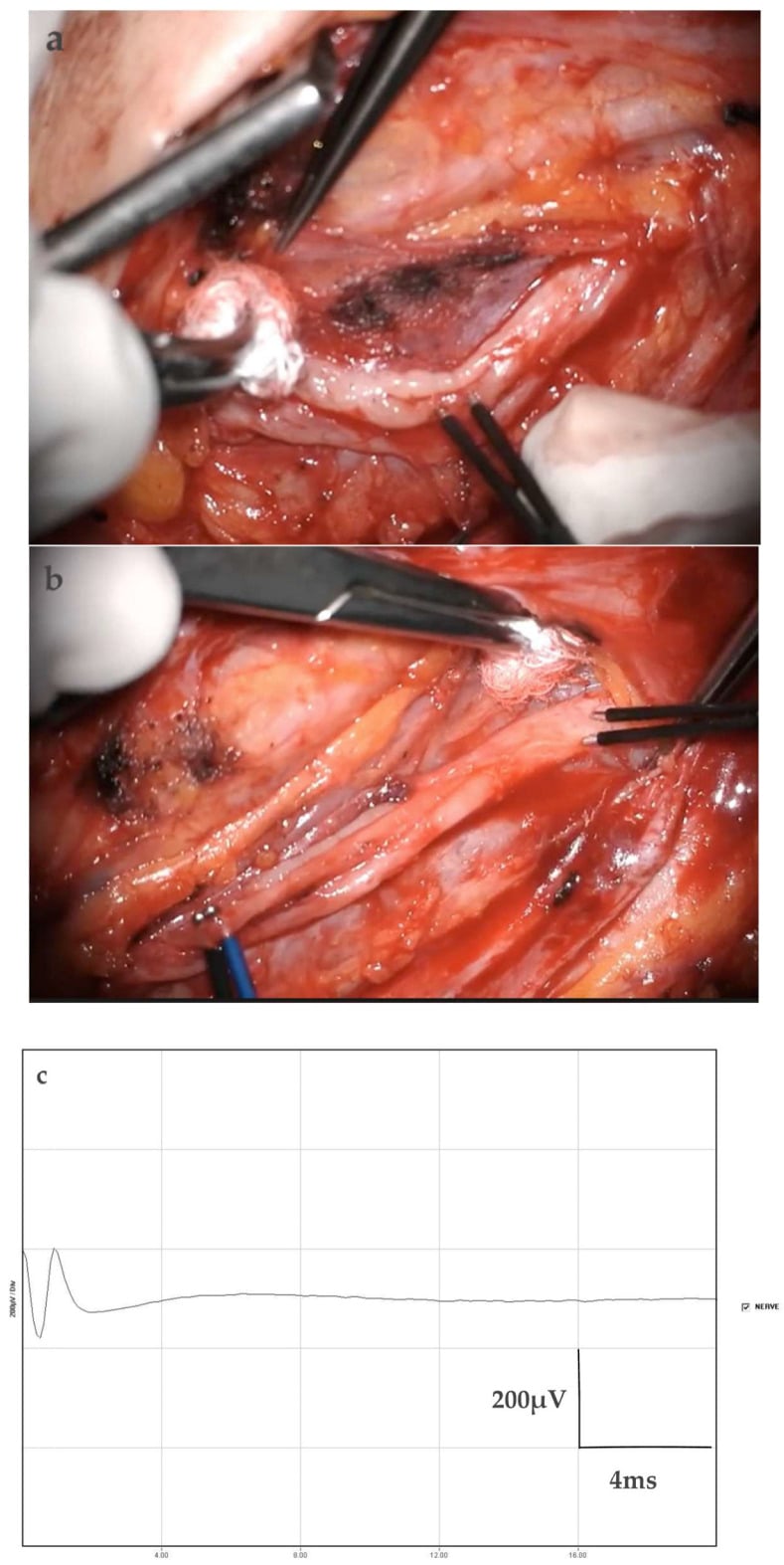Intraoperative Oberlin transfer showing selective ulnar fascicle stimulation, nerve action potential measurement and the recorded waveform.