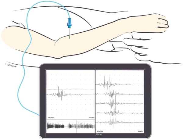 Needle EMG illustration with nascent motor-unit potentials recorded ten weeks after nerve transfer.
