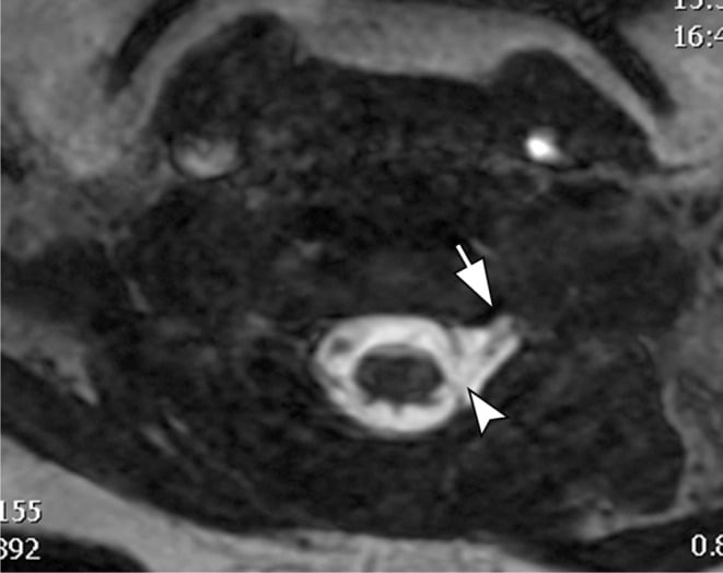 Axial three-dimensional FIESTA cervical MRI showing absent left ventral and dorsal roots with a small pseudomeningocele.