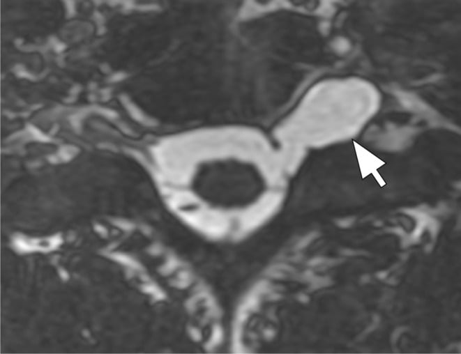 Axial three-dimensional FIESTA cervical MRI showing a left traumatic pseudomeningocele extending through the neural foramen.