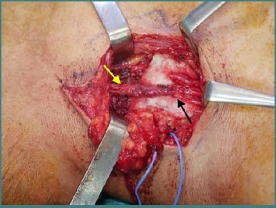 Posterior shoulder operative exposure showing spinal accessory and suprascapular nerves prepared for transfer.