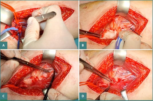 Four-step posterior shoulder operation showing axillary nerve identification, radial triceps fascicle stimulation, division and coaptation.