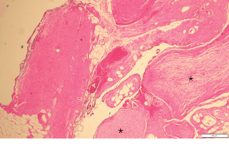 Low-power histology showing enlarged nerve bundles marked by asterisks in plexiform neurofibroma
