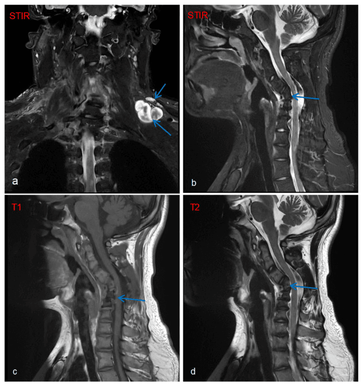 Coronal STIR and sagittal STIR, T1 and T2 MRI showing a target-sign plexiform neurofibroma of the brachial plexus with cervical deformity