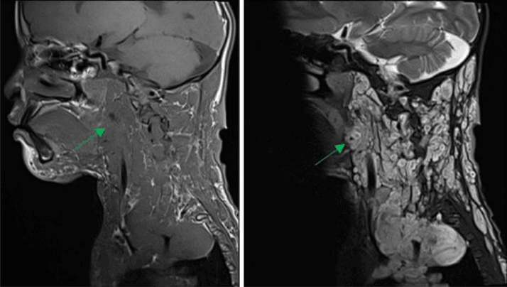 Sagittal cervical MRI showing extensive plexiform neurofibroma with low T1 and high T2 signal