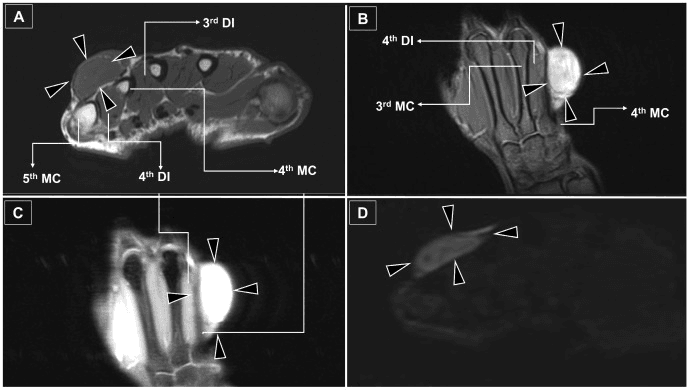 Axial coronal and postcontrast MRI showing a circumscribed dorsal hand neurofibroma over the fourth metacarpal