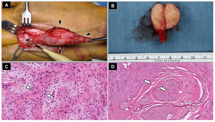 Operative photograph, excised specimen and H&E histology of a dorsal hand neurofibroma