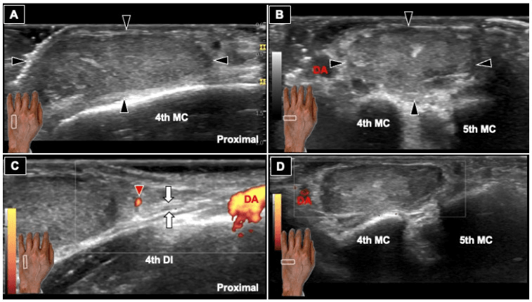 Long-axis, short-axis and Doppler ultrasound showing a well-defined dorsal hand neurofibroma over the fourth metacarpal