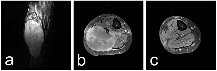 Coronal and axial MRI showing a large hyperintense multilobulated calf neurofibroma