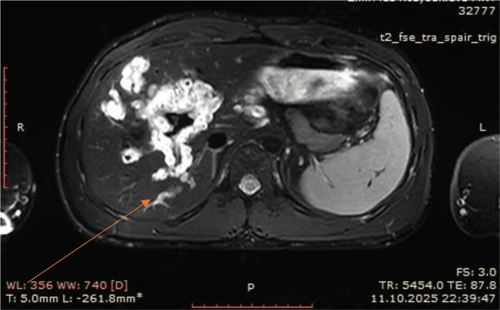 Axial fat-suppressed abdominal MRI showing an extensive branching plexiform neurofibroma in the right liver region