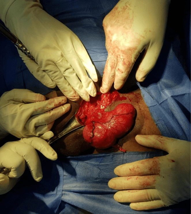 Operative view showing a well-circumscribed inguinal neurofibroma exposed through a regional incision