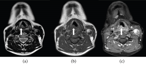 Axial T2 T1 and postcontrast MRI showing a localised arytenoid neurofibroma