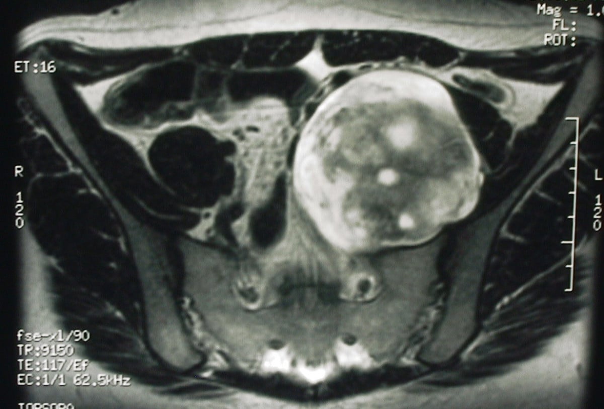 Axial T2-weighted pelvic MRI showing a large, well-circumscribed presacral soft-tissue mass consistent with a neurofibroma.
