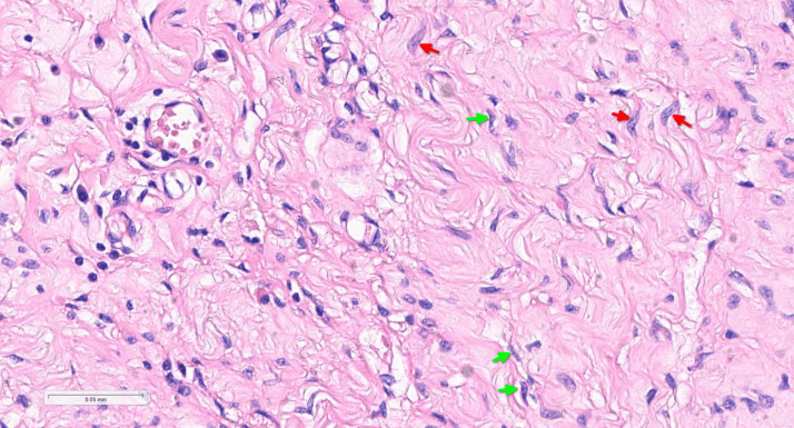 High-power H&E histology showing neurofibroma spindle cells with elongated wavy nuclei marked by arrows