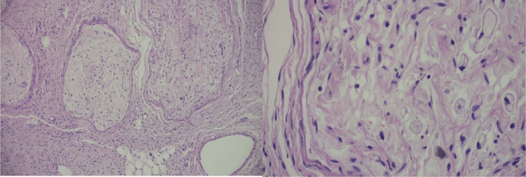 Two-panel histology of plexiform neurofibroma showing expanded nerve bundles at low power and spindle cells with wavy nuclei at higher power
