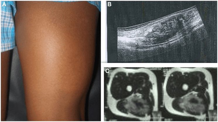 Thigh swelling, ultrasound and axial MRI of a giant neurofibroma arising from the sciatic nerve