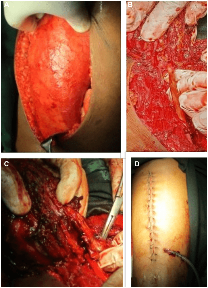 Sequential operative images of a giant sciatic neurofibroma excision and the closed incision with a drain
