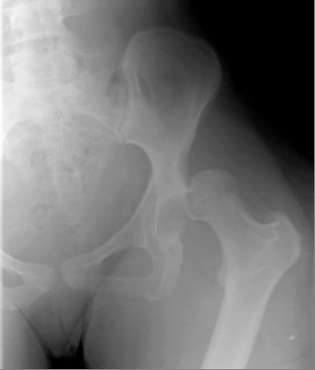 AP pelvis radiograph showing a dislocated left hip in a patient with neurofibromatosis type 1
