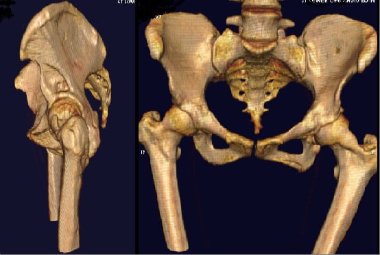 3D CT reconstruction of the pelvis showing erosion of the left femoral neck and acetabulum in a patient with neurofibromatosis type 1