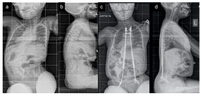 Preoperative and postoperative AP and lateral radiographs of cerebral palsy early-onset scoliosis treated with magnetically controlled growing rods.