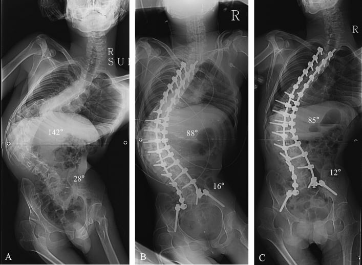 Serial whole-spine AP radiographs of severe cerebral palsy neuromuscular scoliosis before fusion, after iliac fixation and at follow-up.