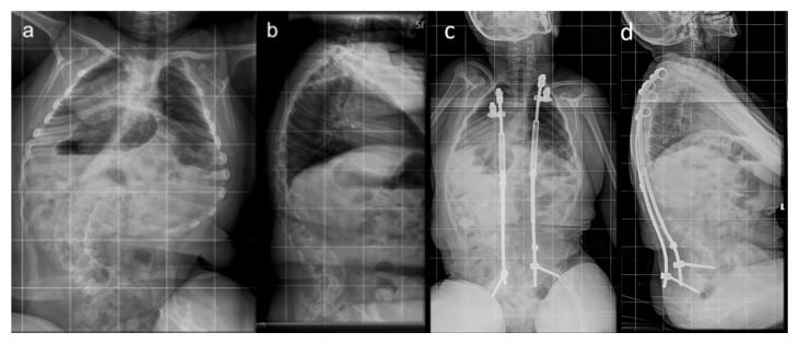 Preoperative and follow-up AP and lateral radiographs of cerebral palsy early-onset scoliosis treated with VEPTR growth-friendly instrumentation.