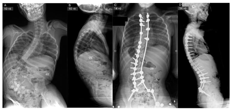 Serial AP and lateral radiographs of severe collapsing Duchenne muscular dystrophy kyphoscoliosis before and after posterior fusion to the pelvis.