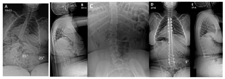 Serial AP and lateral radiographs of Duchenne muscular dystrophy scoliosis including a supine traction view and postoperative fusion.