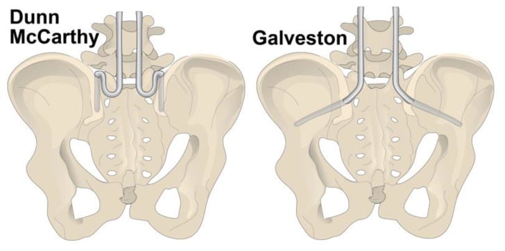 Posterior pelvic schematic comparing Dunn-McCarthy sacral bar fixation with Galveston intrailiac rod fixation.