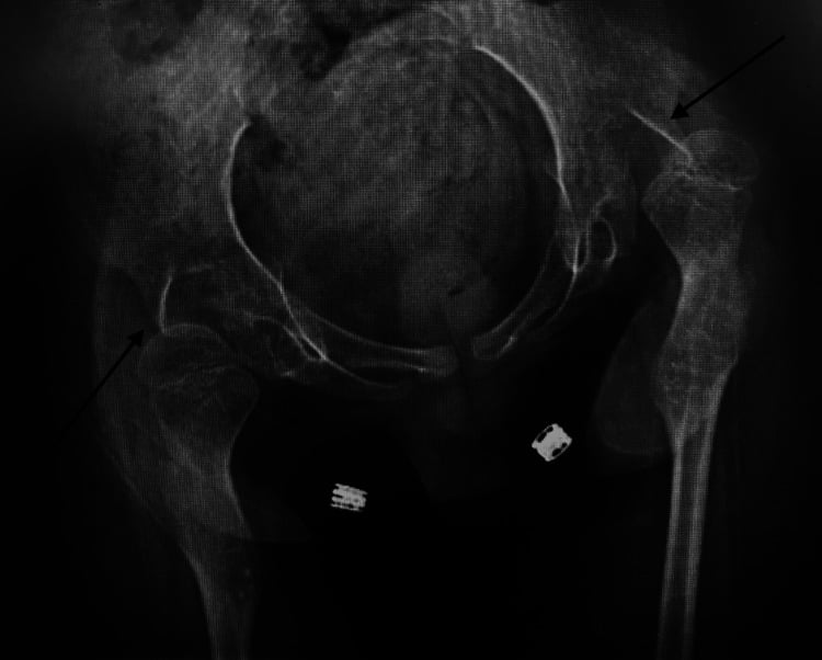 AP pelvis radiograph showing bilateral hip dislocation in a child with neuromuscular scoliosis.