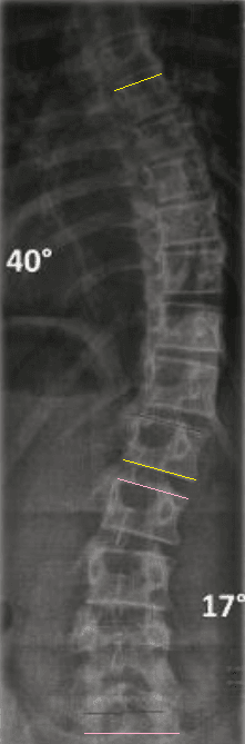 Spine radiograph with Cobb angle measurement of scoliosis curves, showing end-plate lines and curve magnitudes.