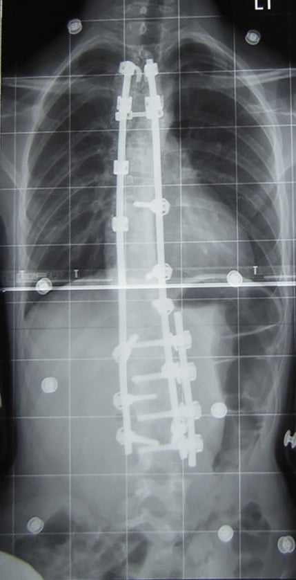 Post-operative AP spine radiograph showing a long posterior instrumented spinal fusion (dual rods and pedicle screws) correcting a scoliosis.