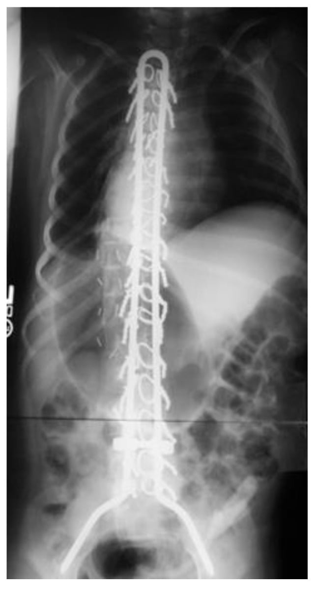 AP radiograph of a Luque-Galveston unit rod construct with segmental sublaminar wiring in neuromuscular scoliosis.
