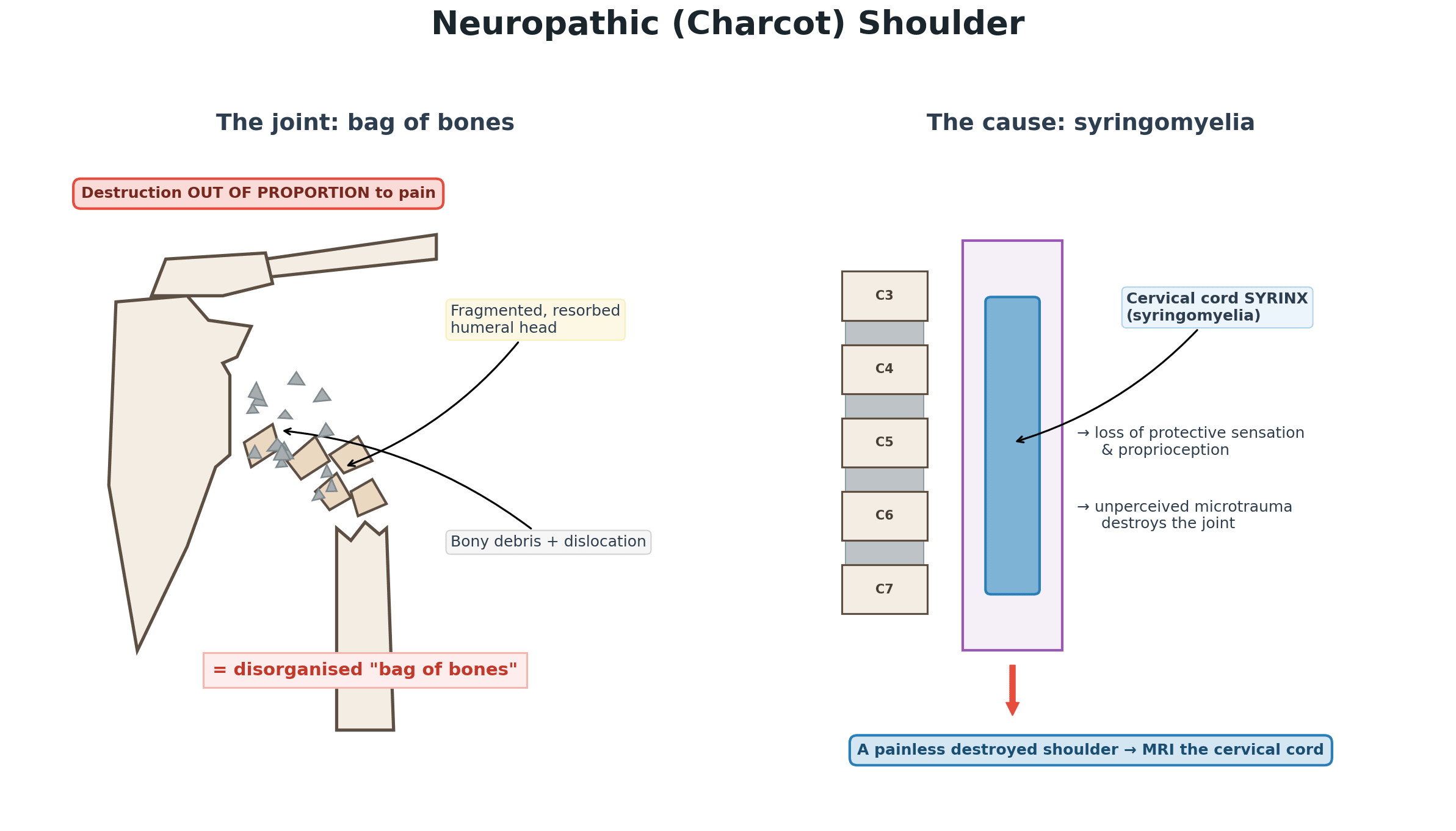 Diagram of a neuropathic Charcot shoulder showing a fragmented humeral head with bony debris and dislocation, alongside a cervical cord syrinx as the cause