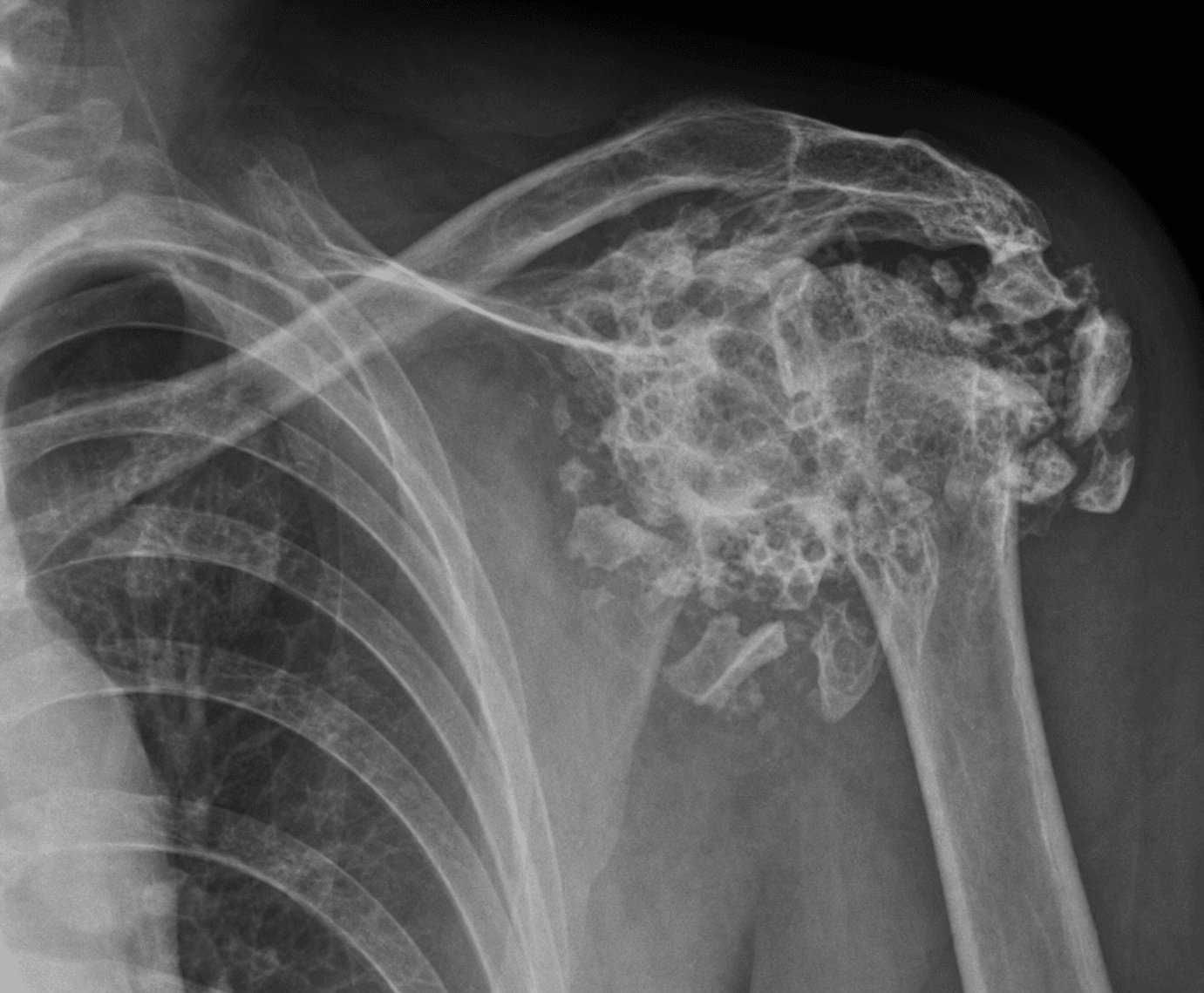 AP radiograph of a severely destroyed neuropathic (Charcot) shoulder with humeral head resorption and bony debris