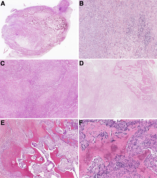 Histology of myositis ossificans showing the zonation pattern and fibro-osseous pseudotumour of the digits