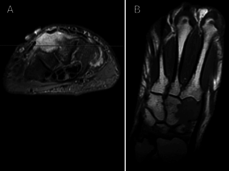 MRI of the wrist showing a T2-hyperintense nodular fasciitis mass eroding into the capitate and trapezium
