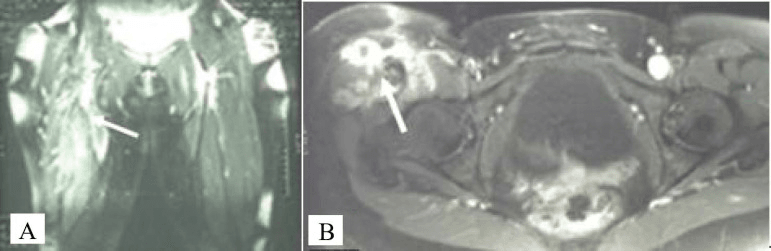 Coronal and axial T2 MRI of the thigh showing an ill-defined intramuscular nodular fasciitis mass