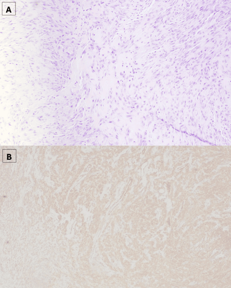 Histology of nodular fasciitis showing spindle and stellate cells on a myxoid background with diffuse SMA positivity