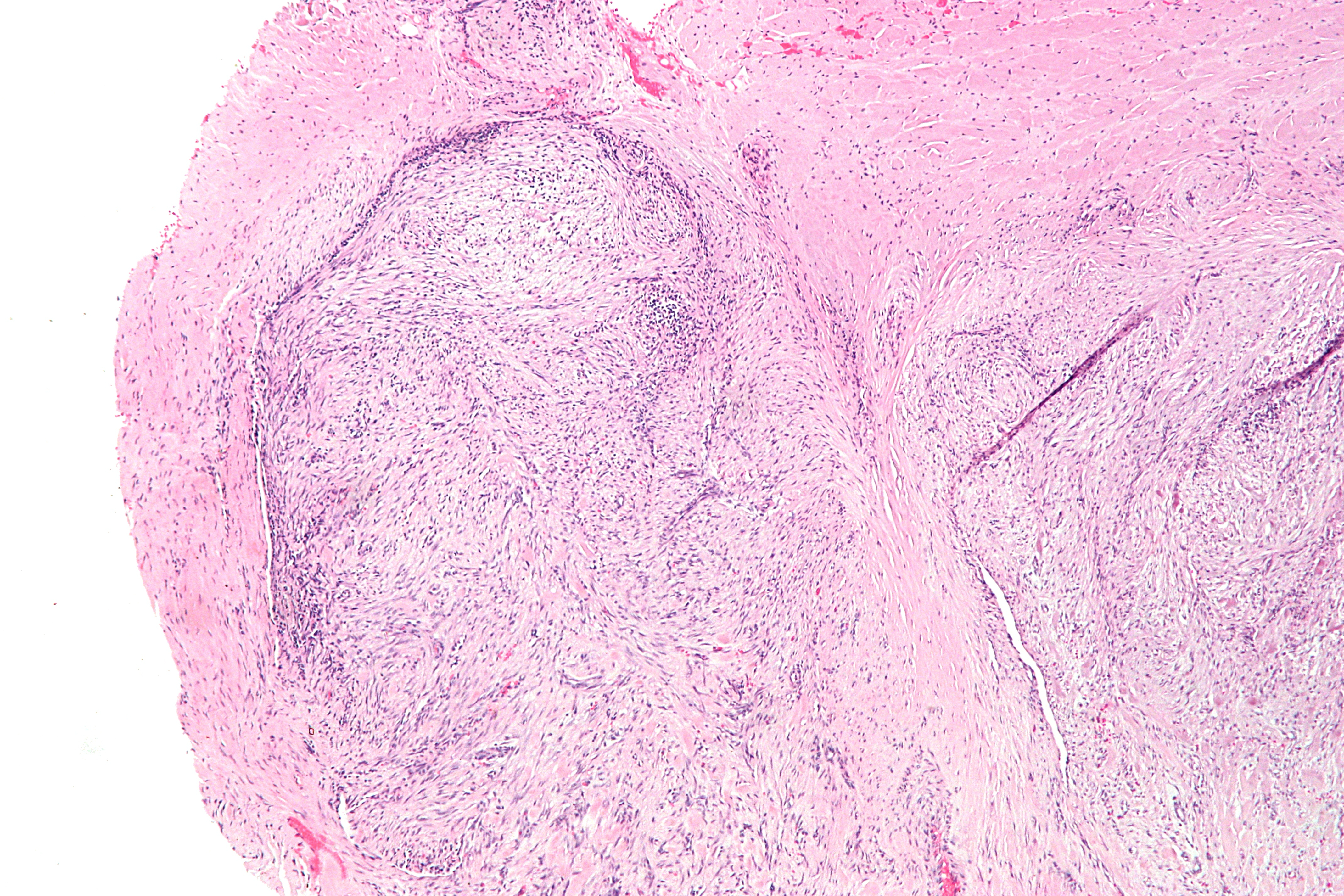 Low-magnification micrograph of nodular fasciitis showing haphazardly arranged spindle cells in a tissue-culture pattern