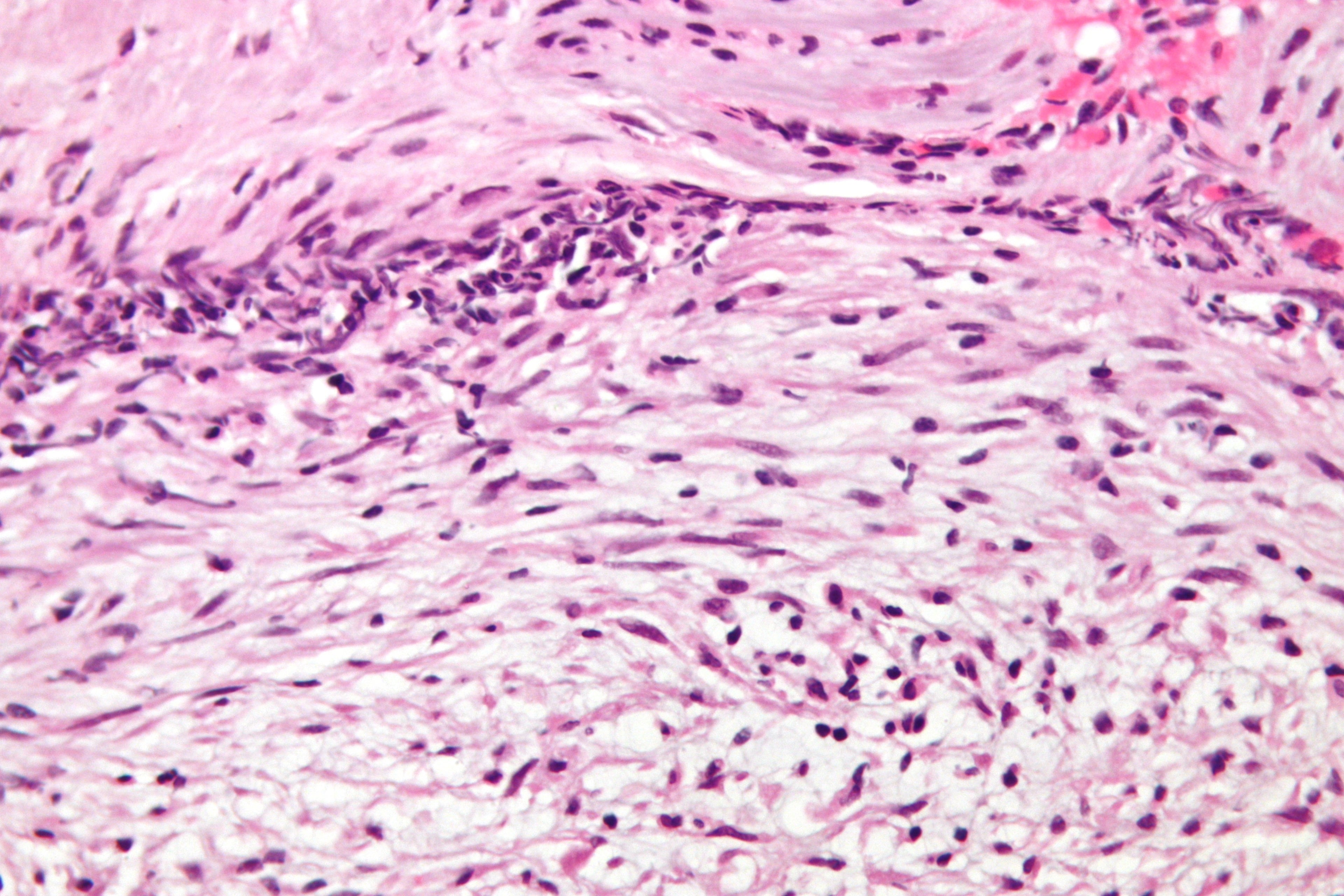 High-magnification H&E micrograph of nodular fasciitis showing plump spindle cells in a loose tissue-culture pattern